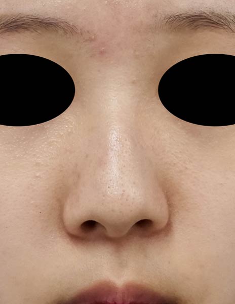 鼻尖縮小（３D法）、Ｉ型プロテーゼ　６か月後　正面のBefore写真