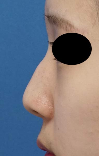 鼻尖縮小（３D法）、Ｉ型プロテーゼ　６か月後　左側面のBefore写真