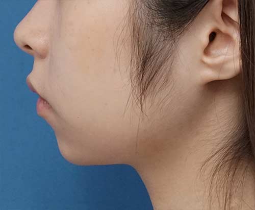 アゴヒアルロン酸（クレヴィエルコントア）　処置直後　左側面のAfterの写真