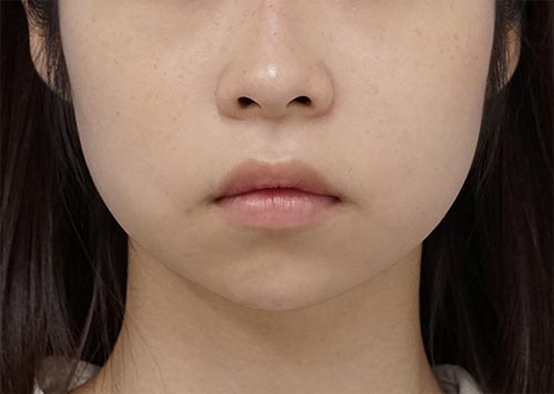 アゴヒアルロン酸（クレヴィエルコントア）　処置直後　正面のAfterの写真