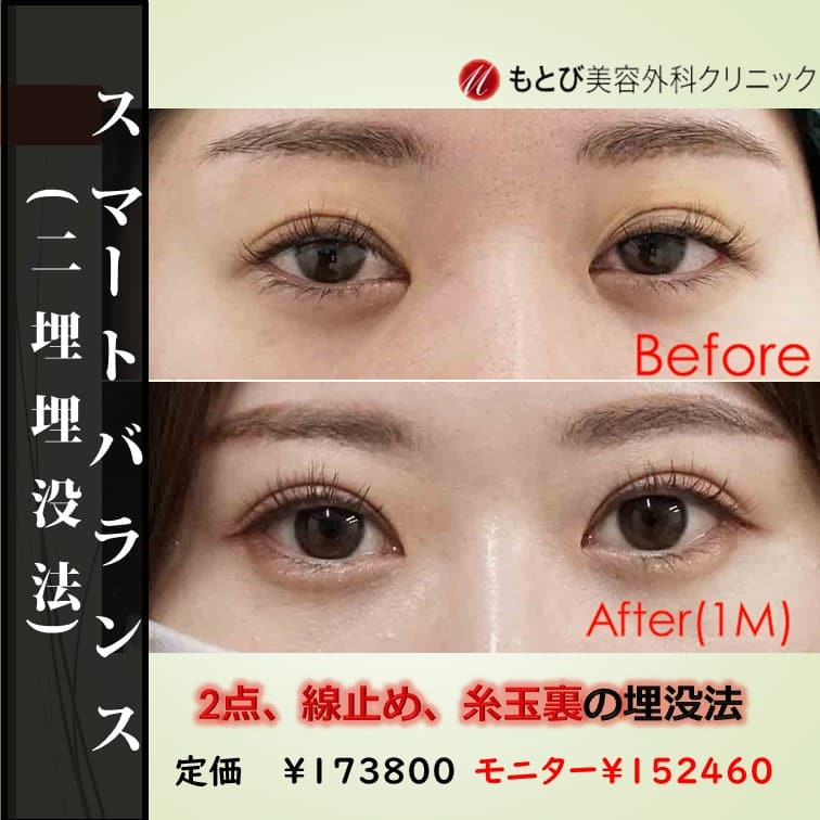 一番人気の二重埋没法、スマートバランス♪ポコつきにくさなら裏止め！