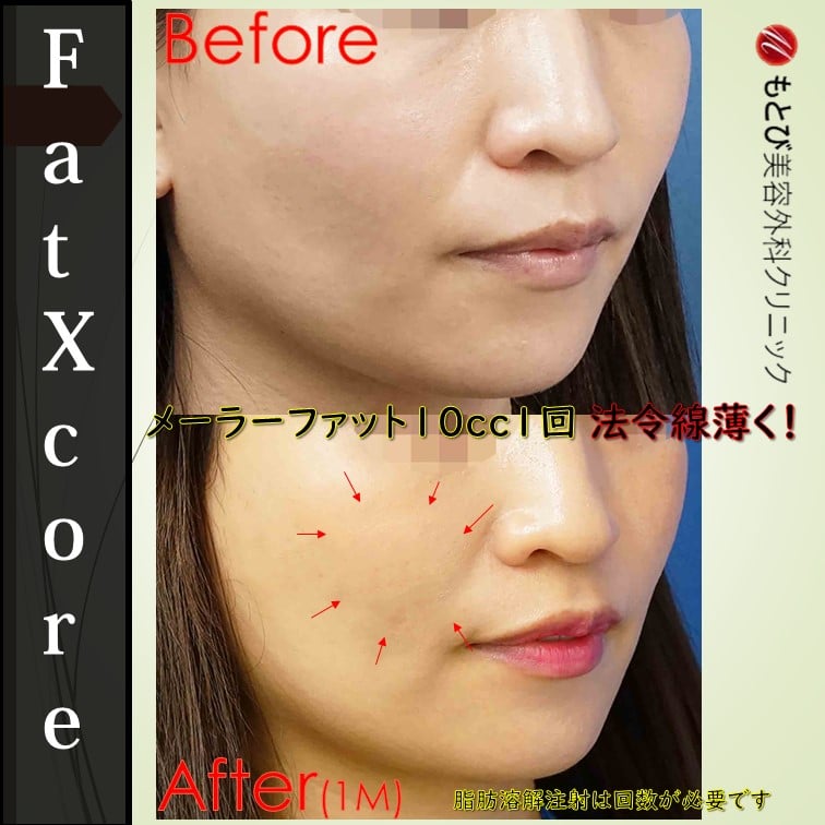 必ず聞かれる！「脂肪溶解注射ってどれくらい腫れますか？」8症例で解説！
