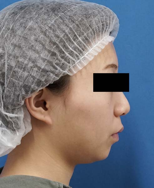小顔脂肪吸引（ホホ・アゴ下）　８か月後　右側面のBefore写真