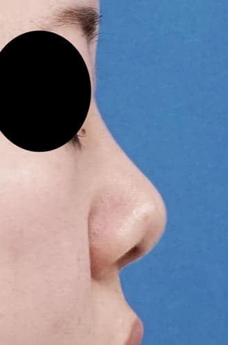 鼻尖縮小、軟骨移植　6か月後　右側面のBefore写真