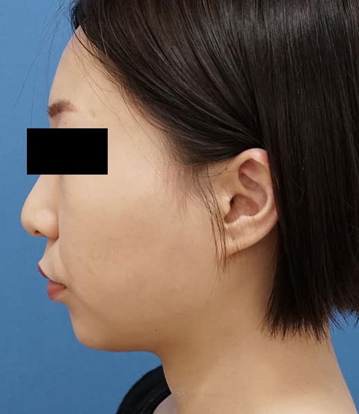 小顔脂肪吸引（ホホ・アゴ下）　８か月後　左側面のAfterの写真