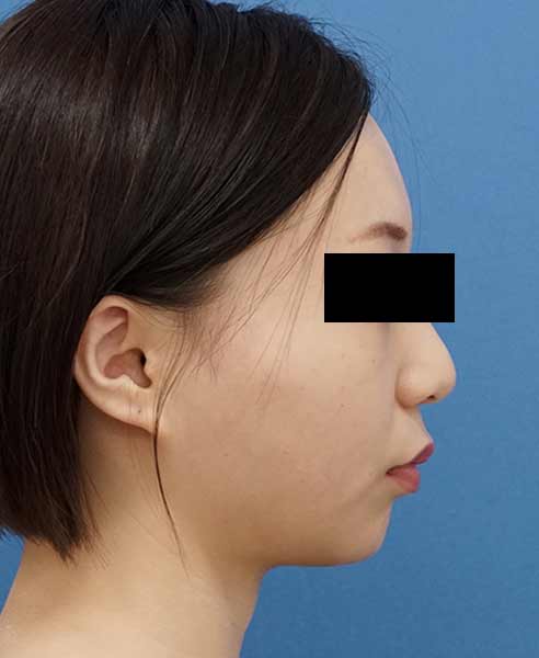 小顔脂肪吸引（ホホ・アゴ下）　８か月後　右側面のAfterの写真