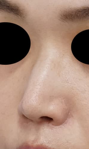 鼻尖縮小、鼻孔縁延長、鼻翼縮小（内側＋外側）　6か月後　左斜めのAfterの写真