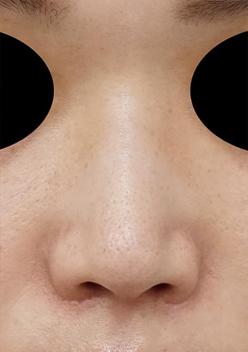 鼻尖縮小、鼻孔縁延長、鼻翼縮小（内側＋外側）　6か月後　正面のAfterの写真