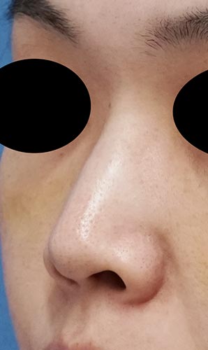 鼻尖縮小、鼻孔縁延長、鼻翼縮小（内側＋外側）　手術前　左斜め