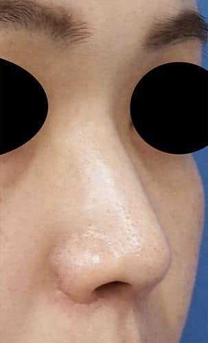 鼻尖縮小、鼻孔縁延長、鼻翼縮小（内側＋外側）　6か月後　右斜めのAfterの写真
