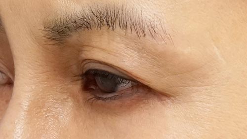 切らないデカ目（眼瞼下垂・たれ目）、目尻切開　手術前　左斜め