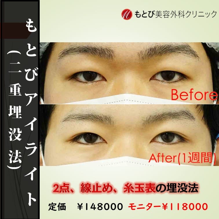 もとびアイライト！最もコスパのいい線留め！モニター価格￥118,000-