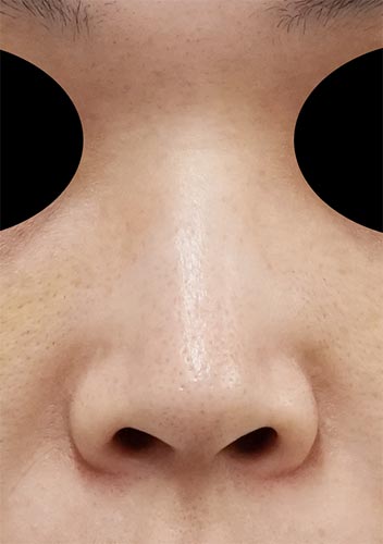 鼻尖縮小、鼻孔縁延長、鼻翼縮小（内側＋外側）　6か月後　正面のBefore写真