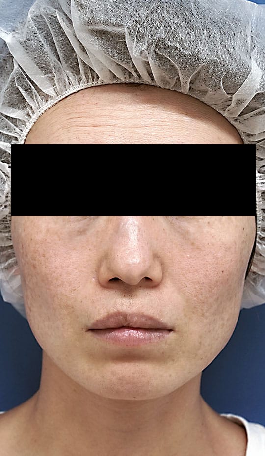 フォトシルクプレミアム　４回処置後のBefore写真