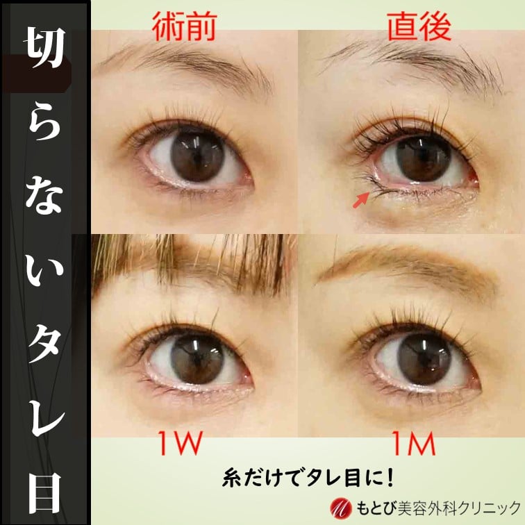 切らないタレ目！ダウンタイム少なく目尻を下げると優しい印象に！