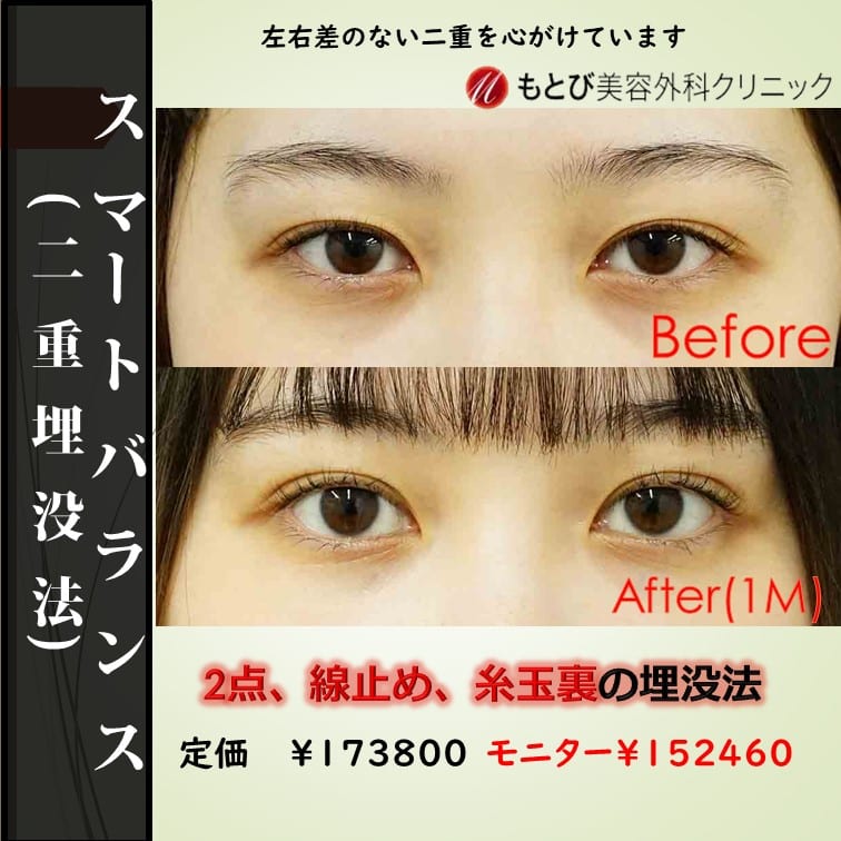 ポコ付きを抑えたいなら裏止め！左右対称な二重にこだわりあり！