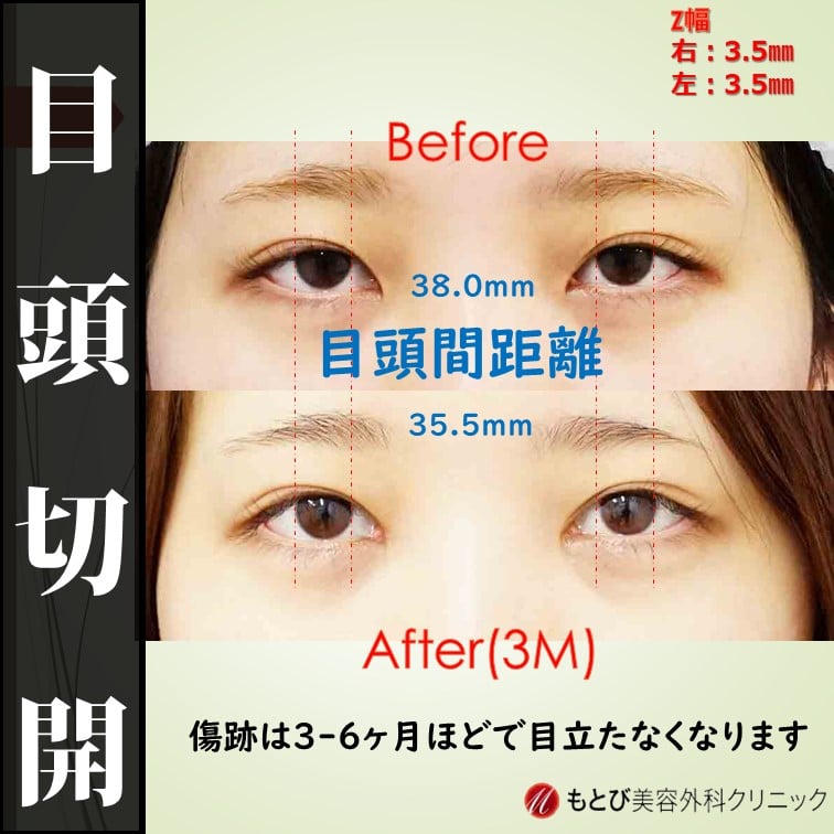 劇的別人級変化！目頭切開で印象はここまで変わります！