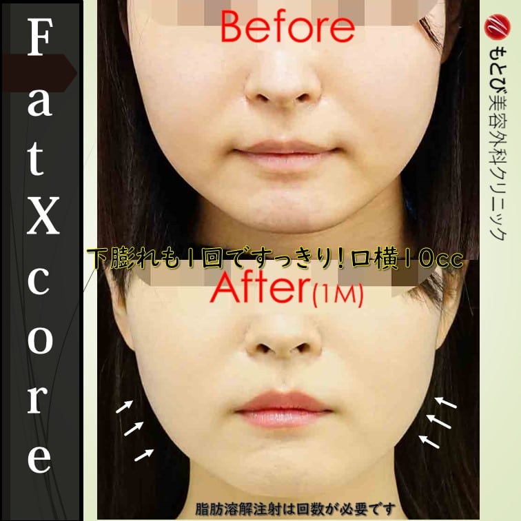 最も効果の高い脂肪溶解注射Fat Xcore!１回でも効果を実感する人がいます。