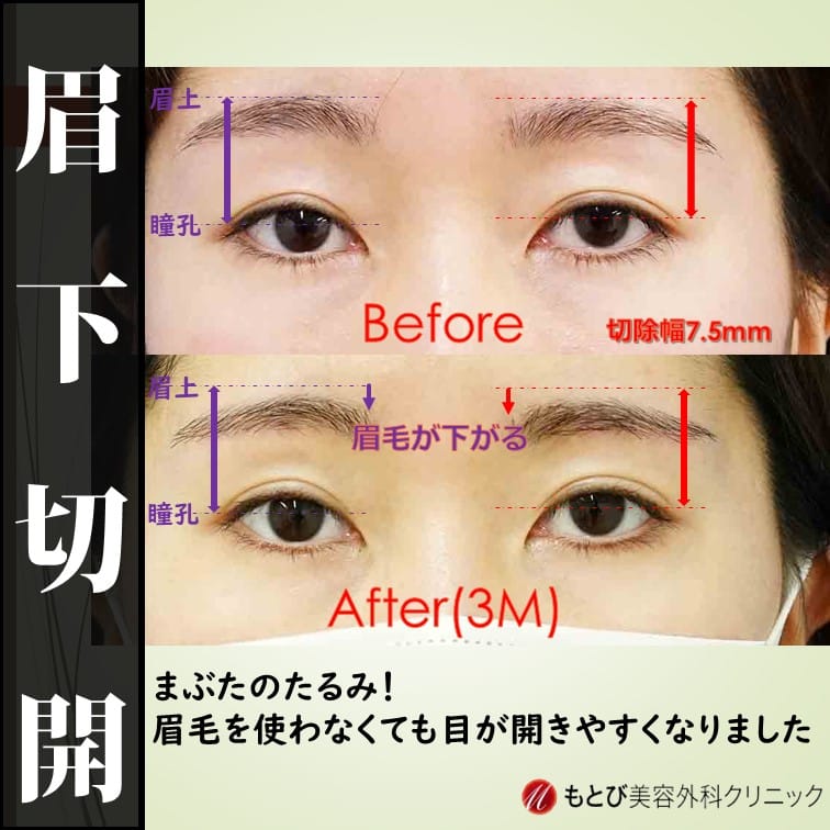 眉下切開後に眉毛下がると、見た目さほど変わらない(目が開けやすくなる実感はあり)