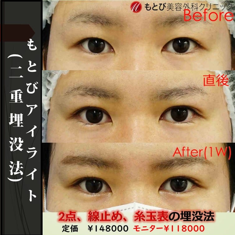 直後なのにほぼ完成！もとびアイライト！極細7-0の糸で腫れが少ない！