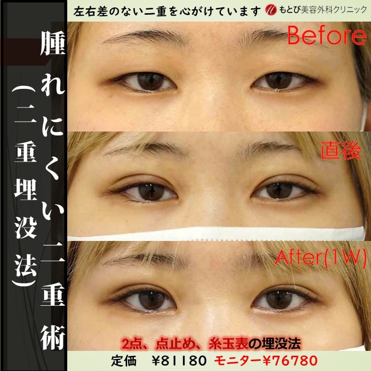 腫れにくい二重術！両目２点で￥81180-！１年以内なら幅変更保証付き！