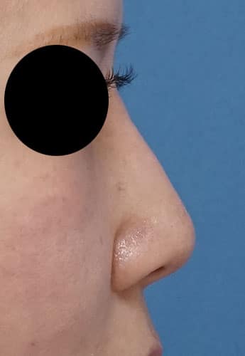 鼻尖縮小、軟骨移植、ストラット、Ｉ型プロテーゼ　6か月後　右側面のAfterの写真