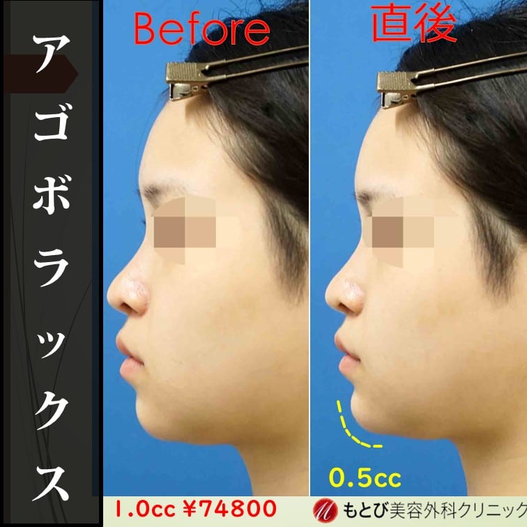 アゴヒアルは少しずつ入れては鏡で確認。をした方が、入れすぎることはなくて安心。