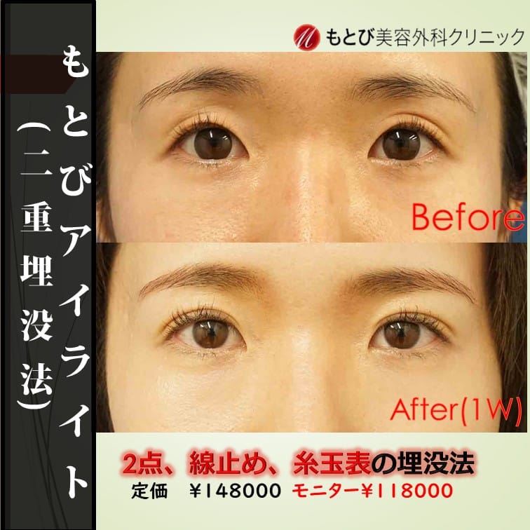 くぼみ目が強いと埋没しても二重になりません。くぼみが軽ければ埋没できるかも。