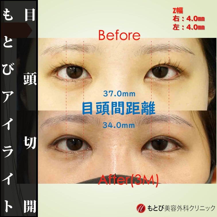 目頭切開＋もとびアイライト！最も手軽に垢抜けできる最強の組み合わせ！