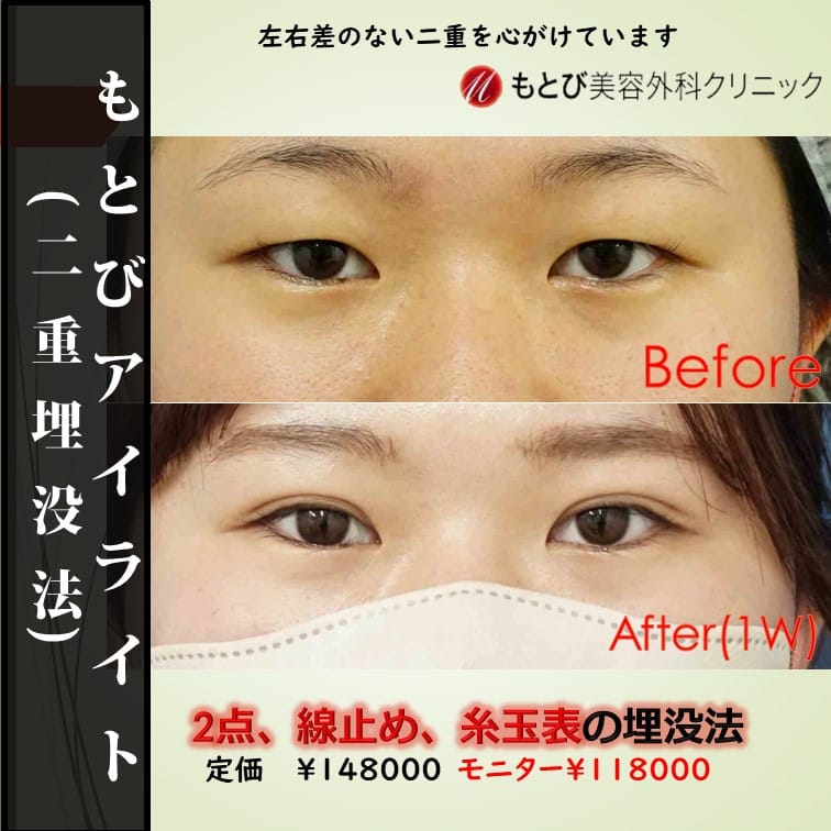 もとびアイライト！もっともリーズナブルな線留め！自然癒着法！