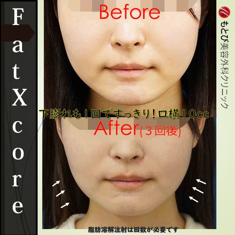 脂肪溶解注射・FatXcoreは３回すれば結構脂肪減る。