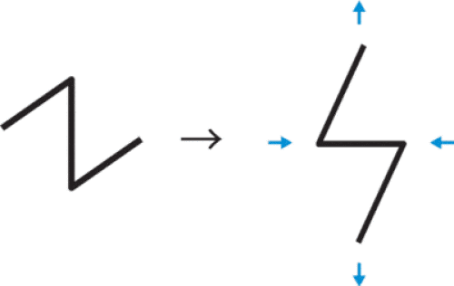 Z形成　切開簡易図１