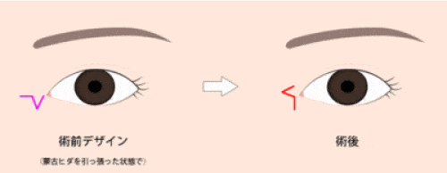 Z形成　目頭切開　切開簡易図2