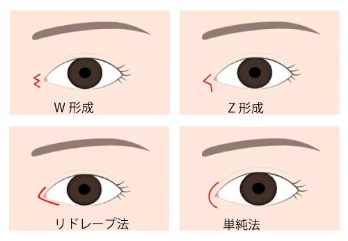 目頭切開種類　単純法　リドレープ法　Z形成　W形成