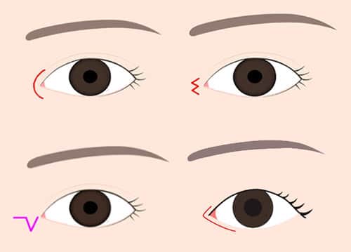 目頭切開　切開法まとめ図
