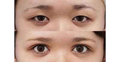 二重全切開・眼瞼下垂（挙筋前転）・目頭切開（Z形成）　手術直後～３か月後経過