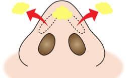 鼻尖縮小　軟部組織除去　３D法イラスト③