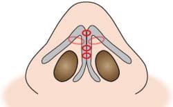 もとびの鼻尖縮小術　イラスト③