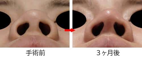 コラム用　症例写真③　鼻整形オープン法下から