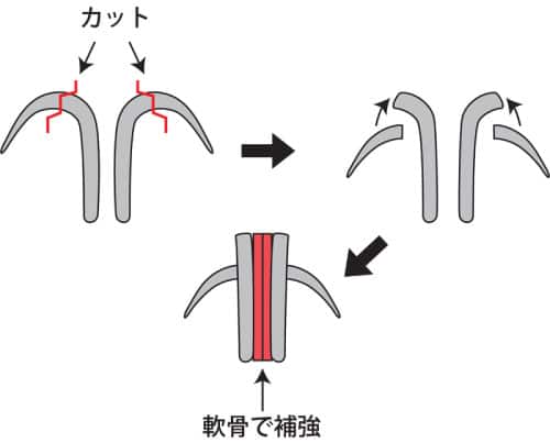 3D法鼻翼軟骨形成のやり方　イラスト