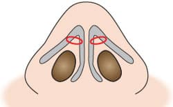 もとびの鼻尖縮小術　イラスト①