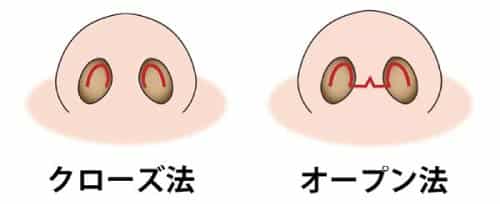 コラム用　クローズ法とオープン法の傷