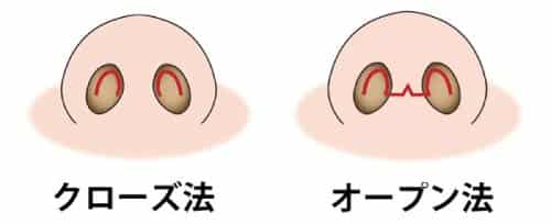 コラム用　クローズ法とオープン法の傷