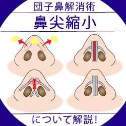 【医師が解説】団子鼻が気になる方におススメ鼻尖縮小術について【通常の鼻尖縮小と３D法の違い】