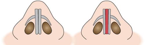 もとびの鼻尖縮小術-3D法②