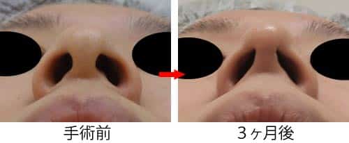 コラム用　症例写真④　鼻整形オープン法下から