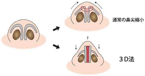 通常の鼻尖縮小と３D法　まとめイラスト
