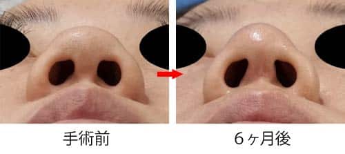 コラム用　症例写真①　鼻整形オープン法下から