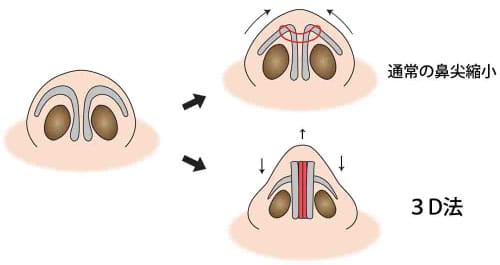 コラム　鼻尖縮小のリスク　図④通常の鼻尖縮小と３D法のイラスト