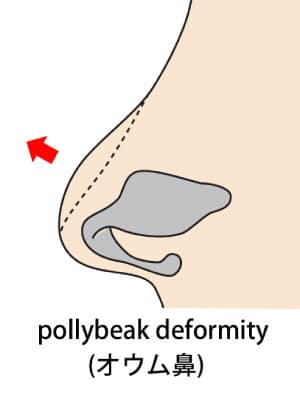 コラム　鼻尖縮小のリスク　pollybeak-deformity(オウム鼻)